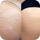 Stretch Mark Removal
