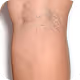 Vein Removal