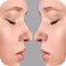 Non-Surgical Rhinoplasty