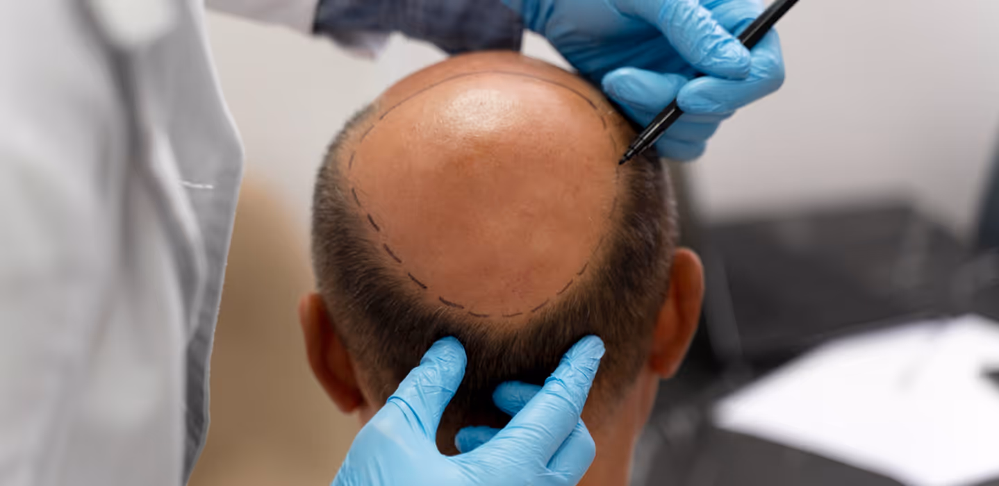 Hair Restoration
