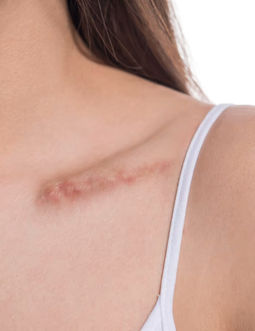 Scar Revision