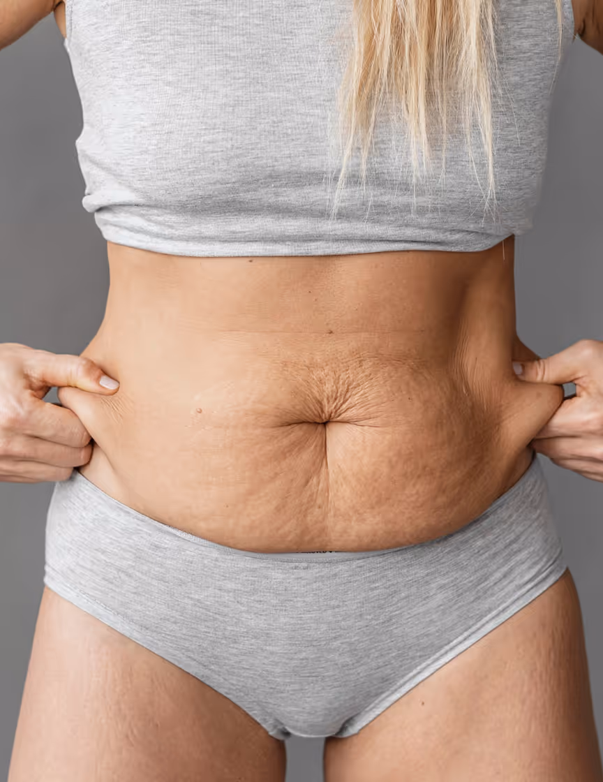 Stretch Marks