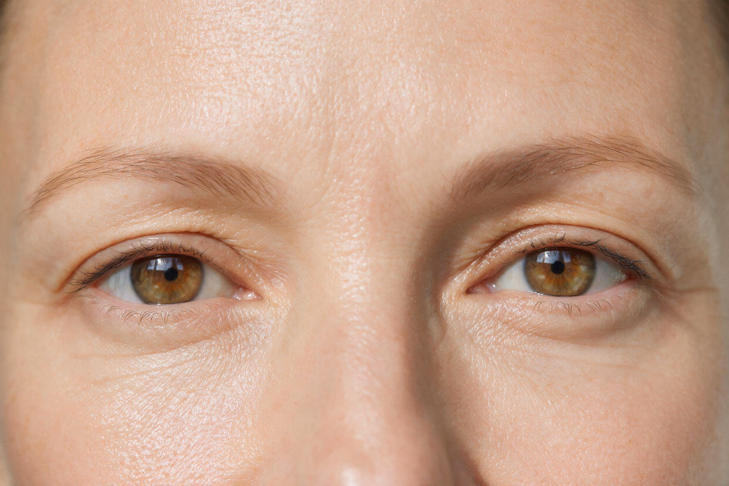 Neustem for Under Eye Hollows and Dark Circles