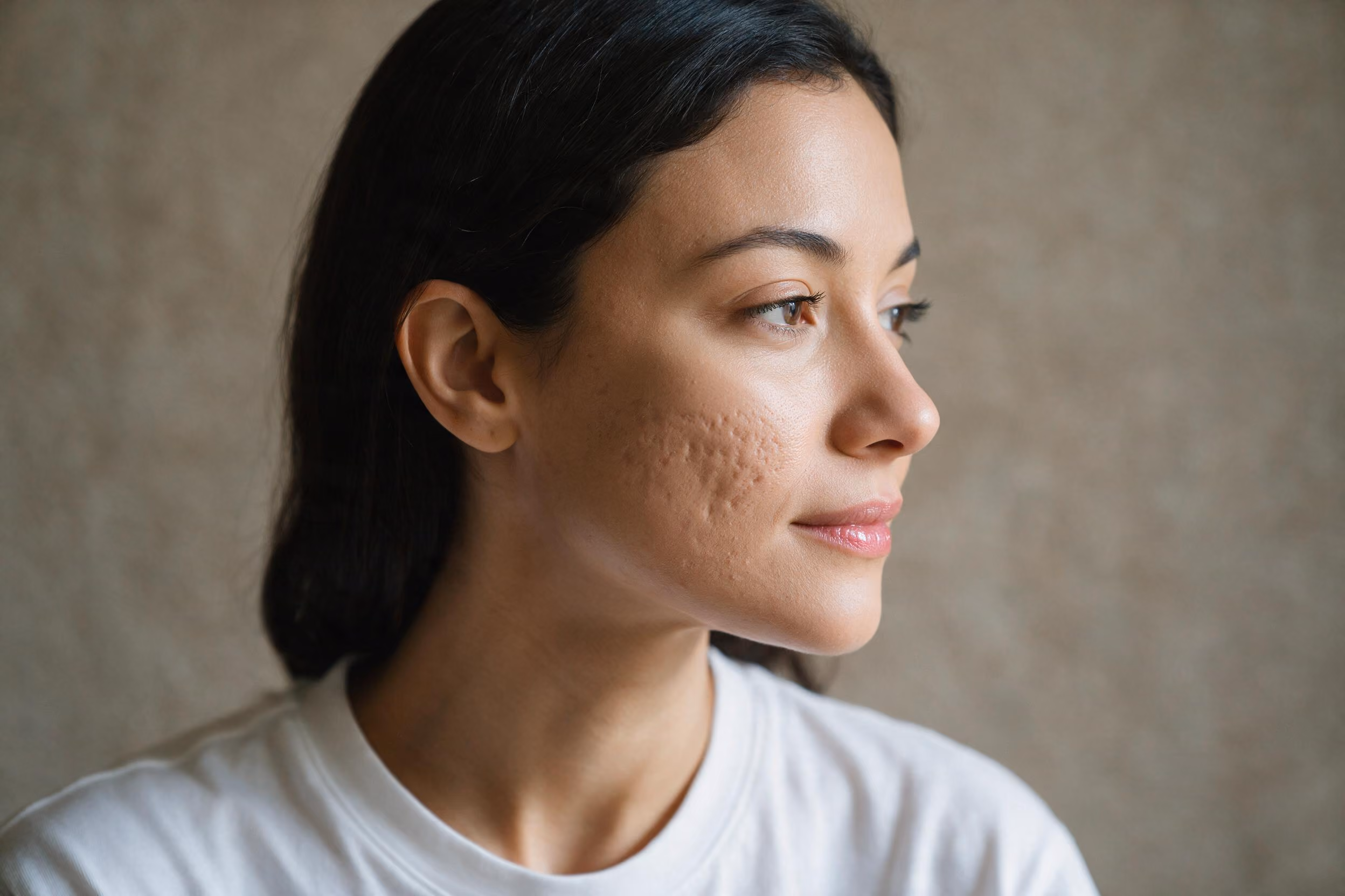 Coolaser for Acne Scarring