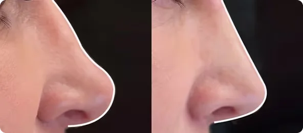 Photo comparison showing two side profile views of a nose