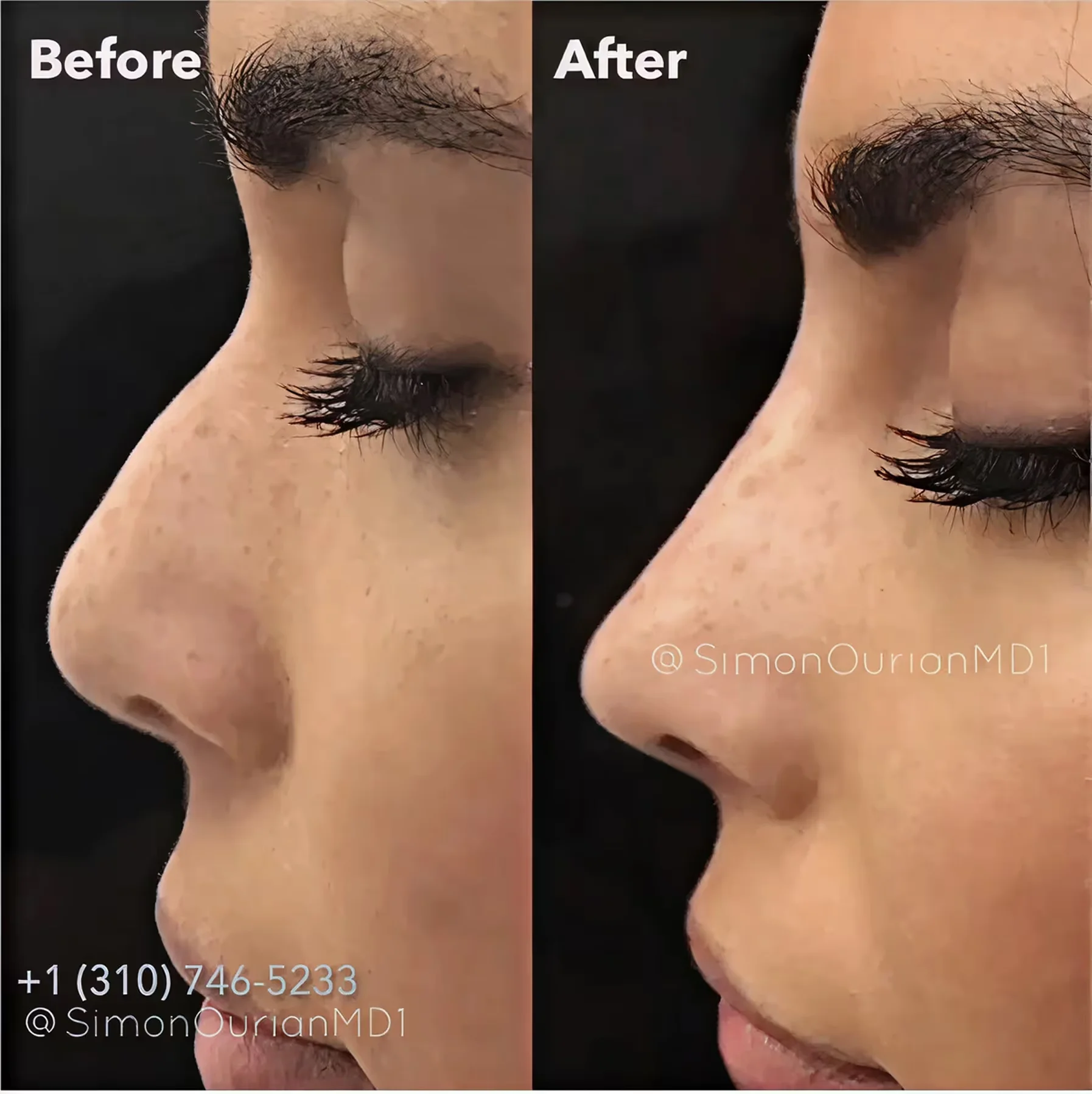 Photo of before and after side profile views of a nose