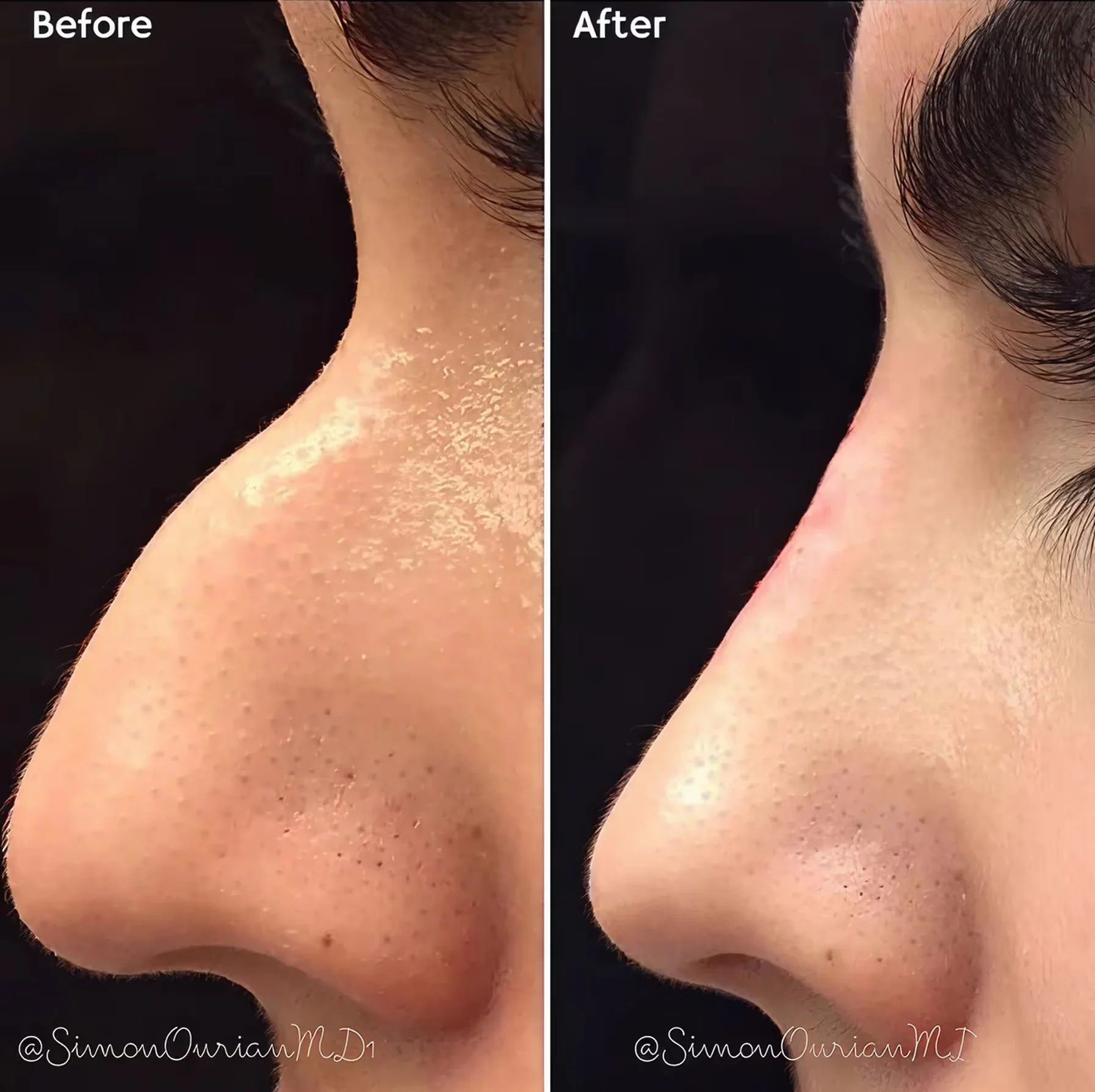 Photo showing before and after side profile views of a nose