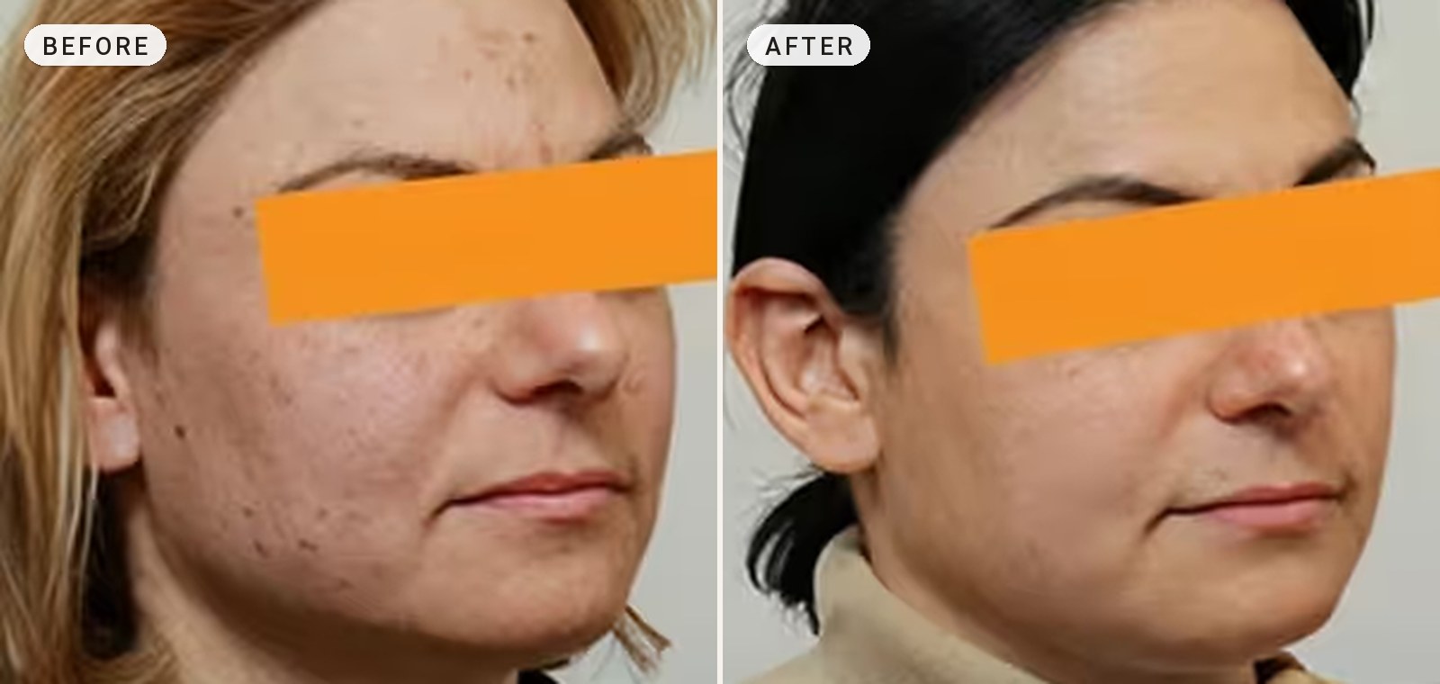 Skin Resurfacing 06