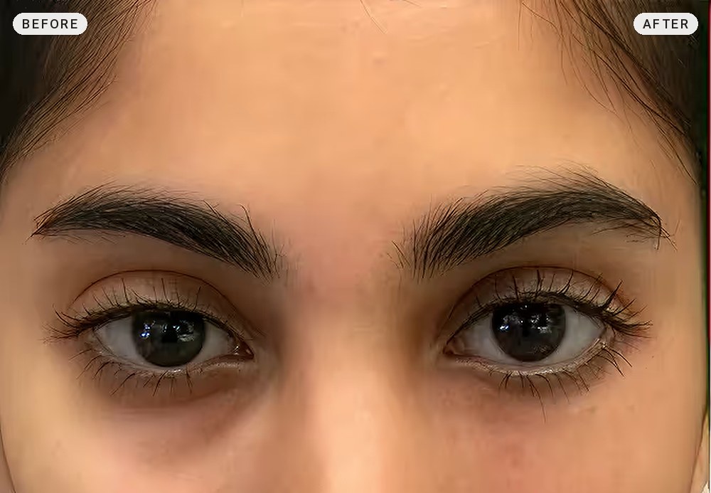 Dark Circles & Eye Bags 02