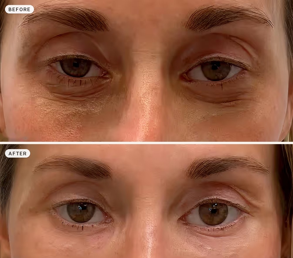 Dark Circles & Eye Bags 17