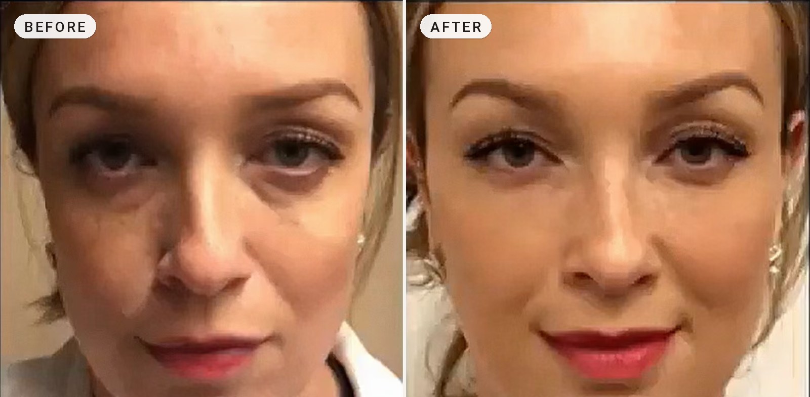 Dark Circles & Eye Bags 21
