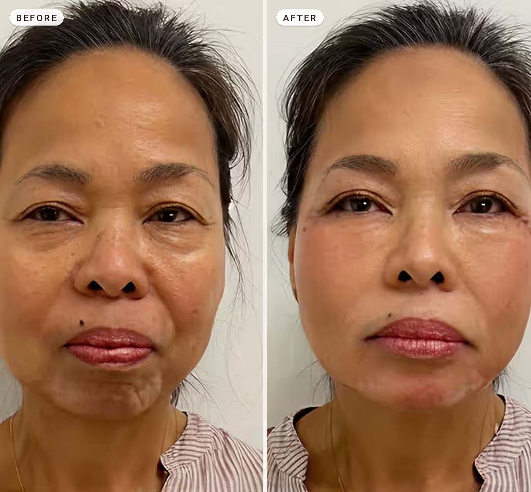 Non Surgical Facelift 01