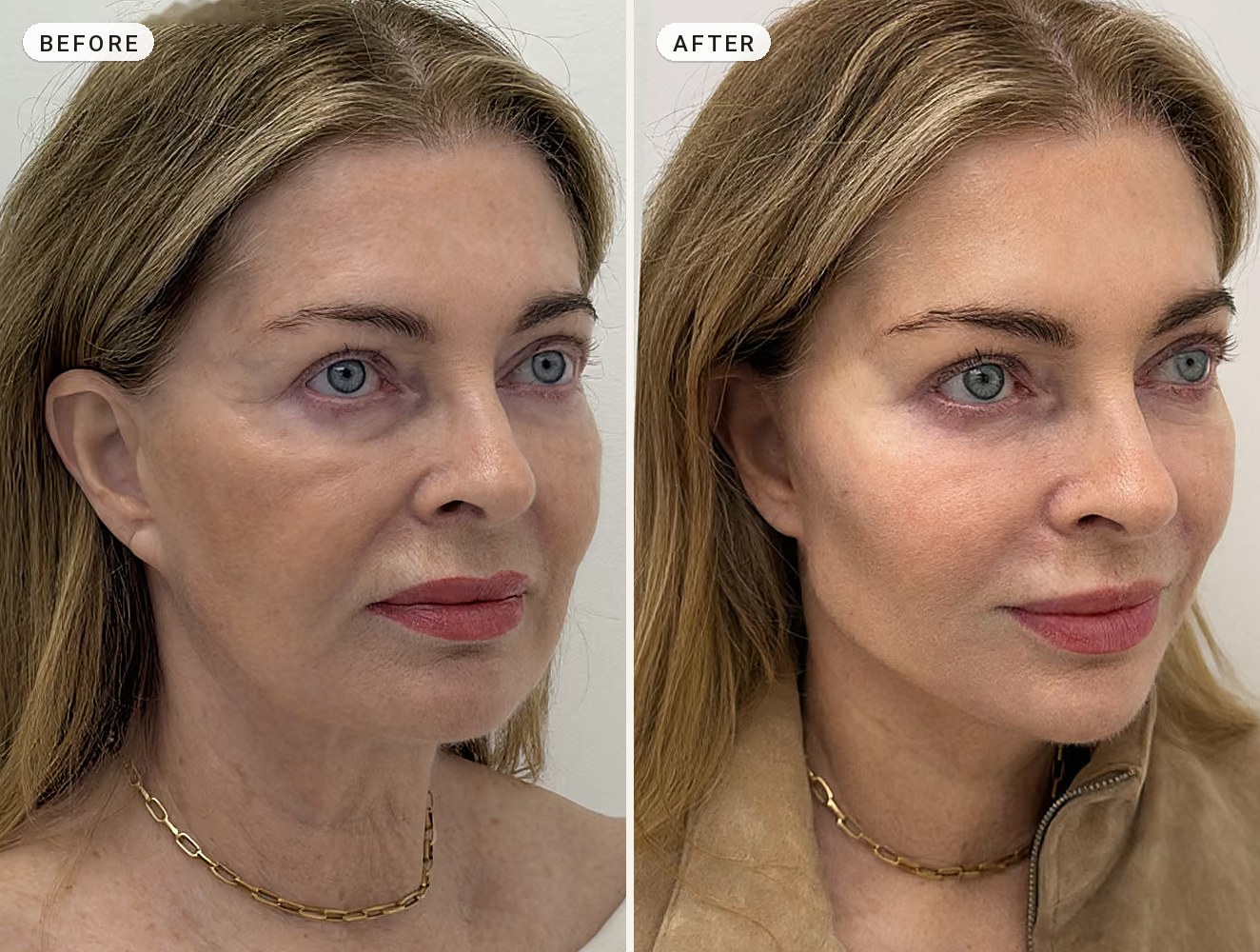 Non Surgical Facelift 07