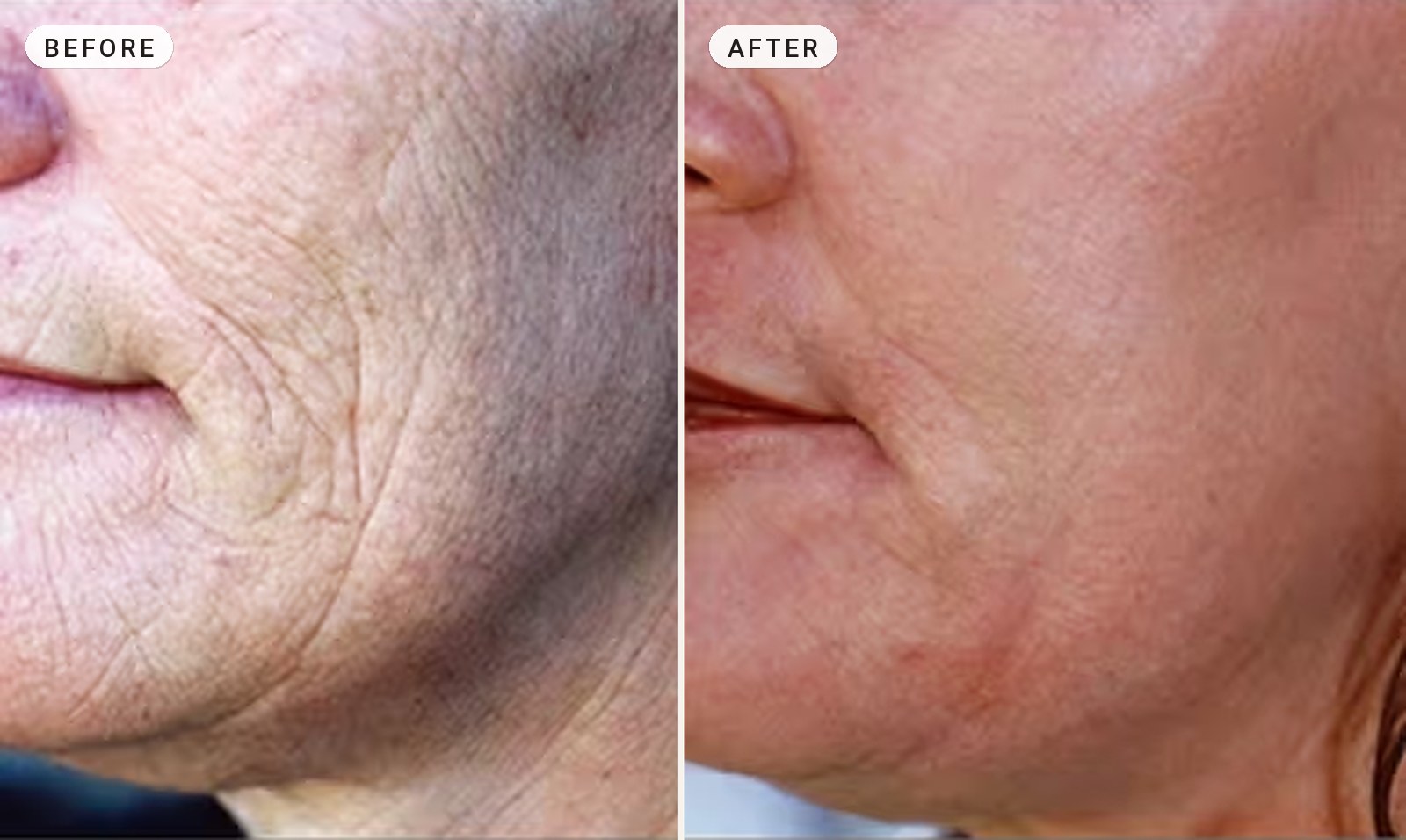Wrinkle Removal 08