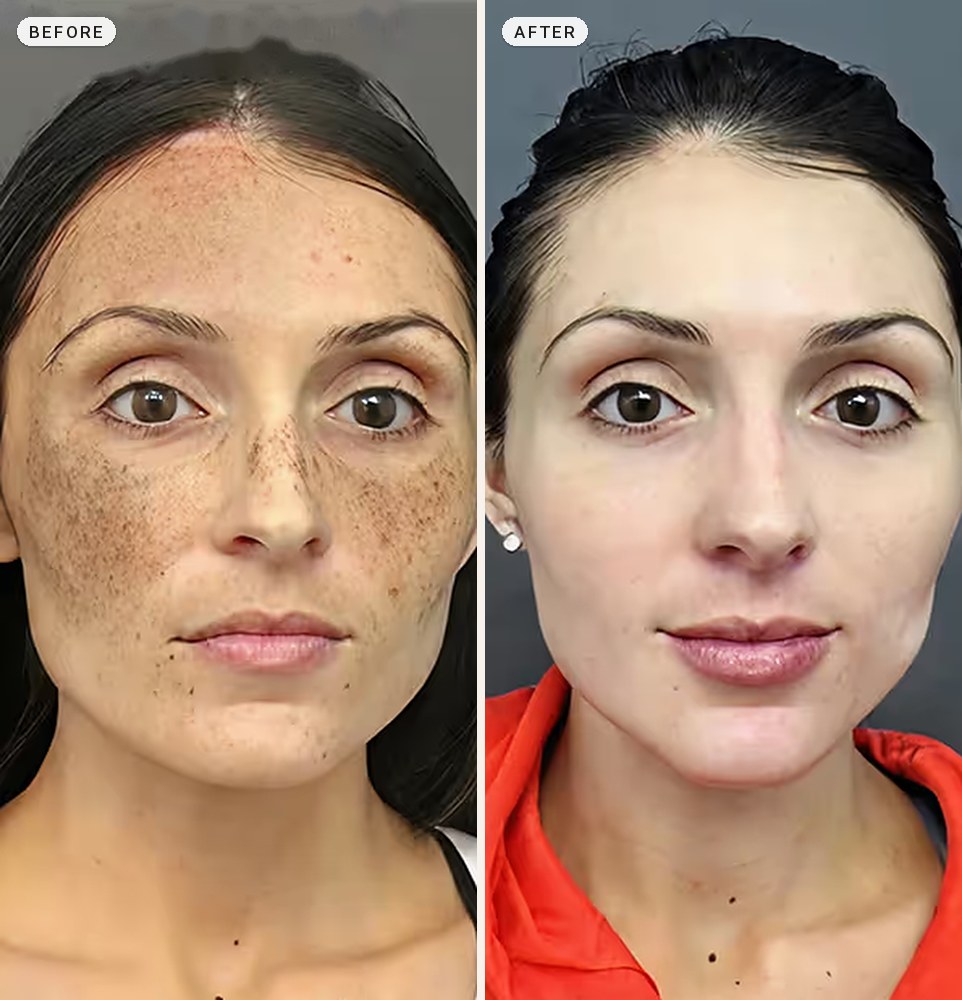 Melasma Treatment 03