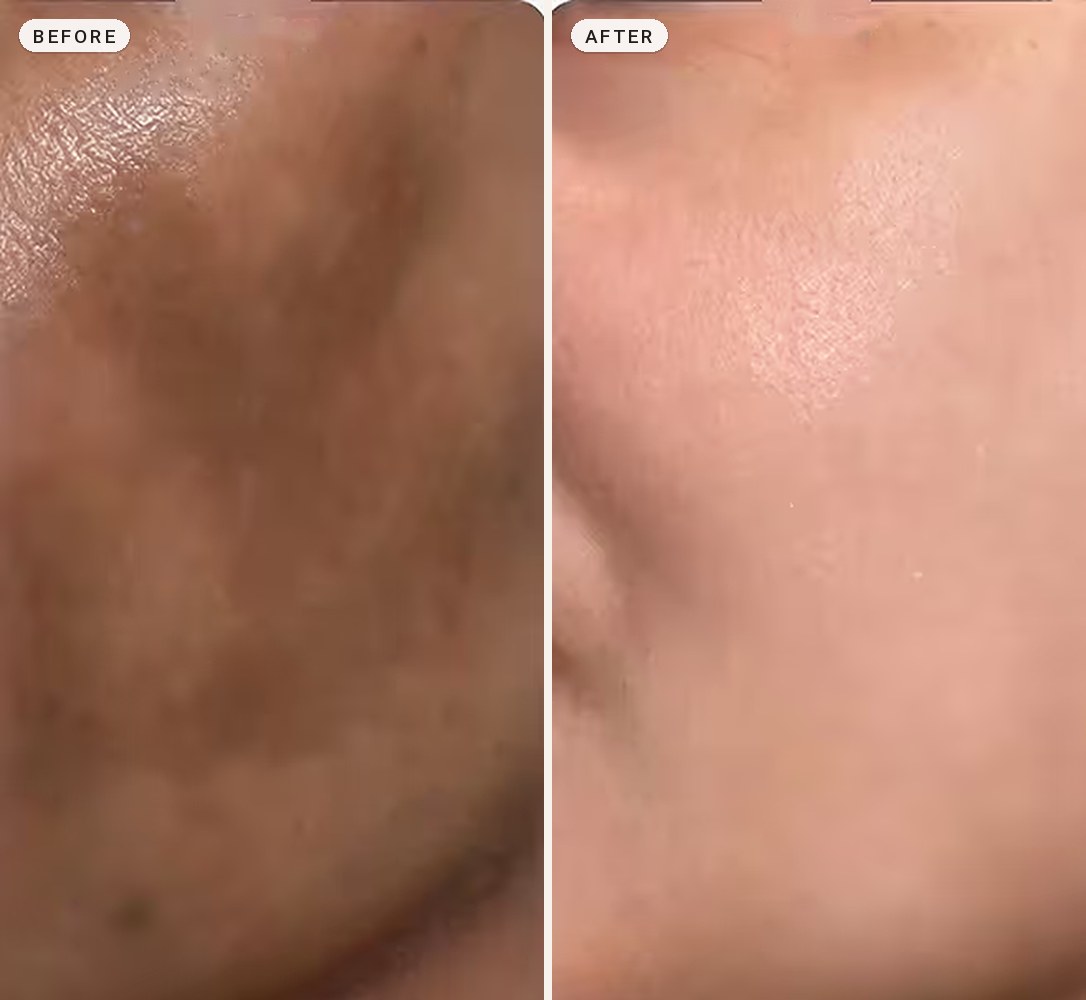 Melasma Treatment 05
