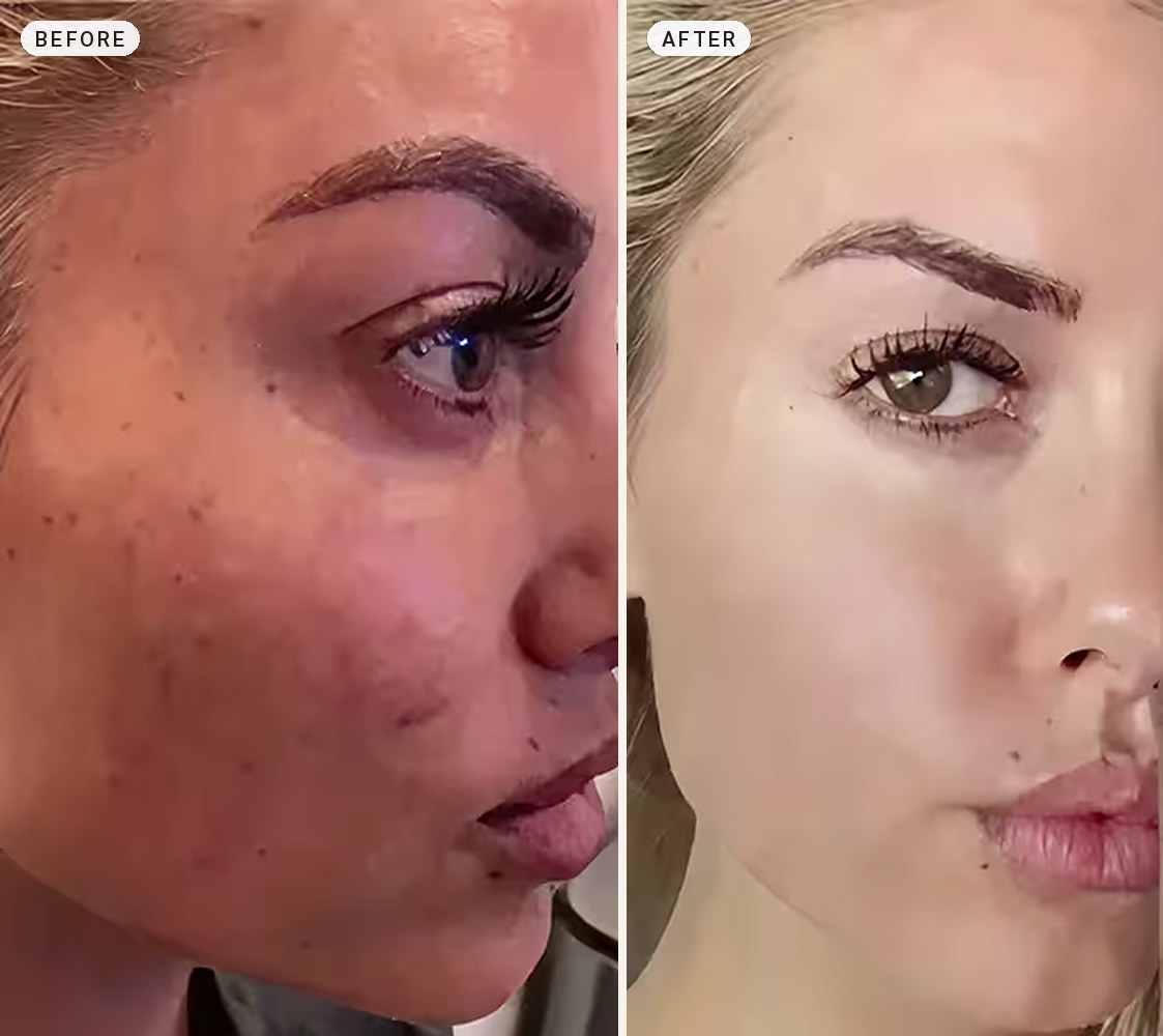 Melasma Treatment 06