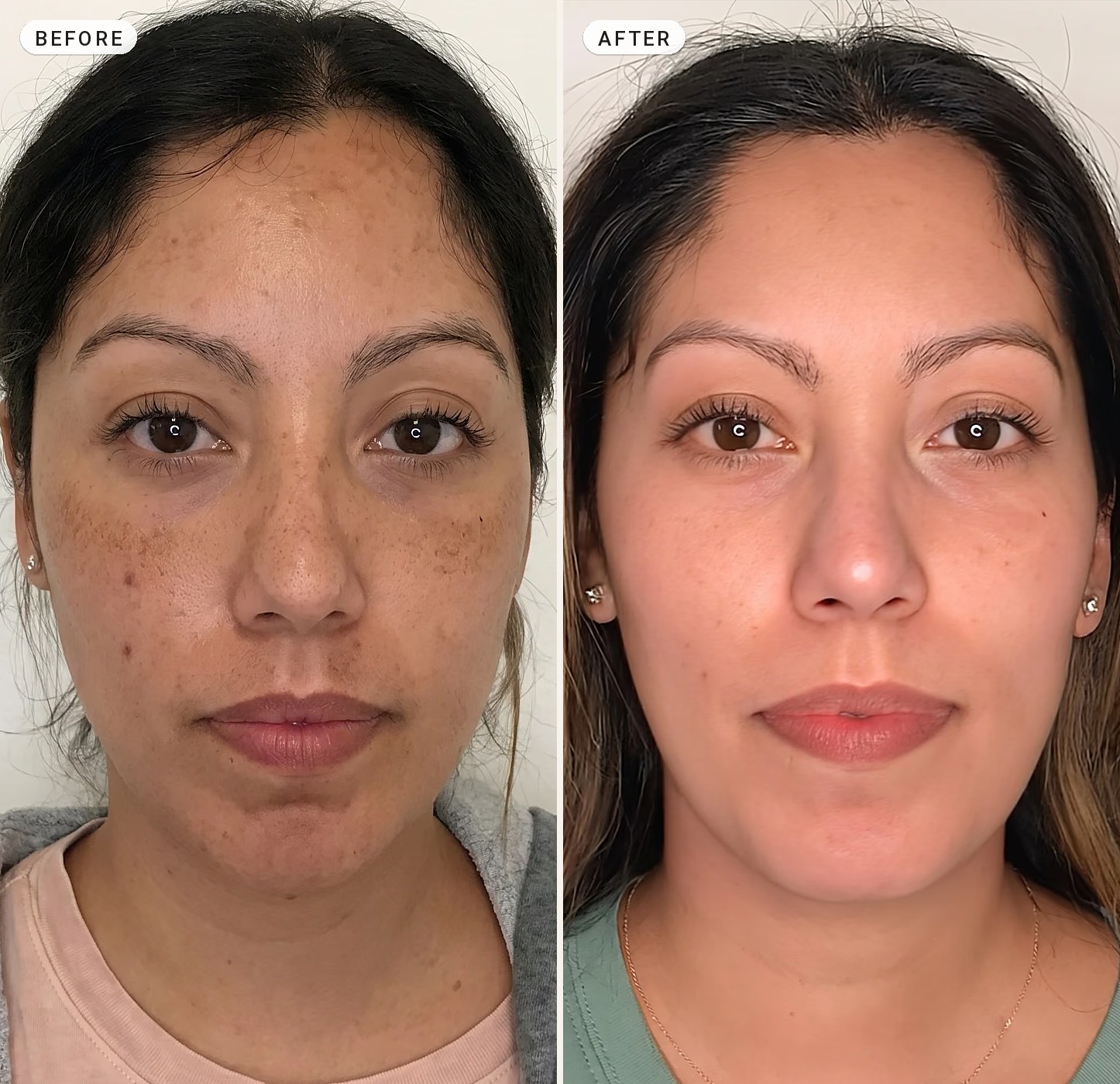 Melasma Treatment 07