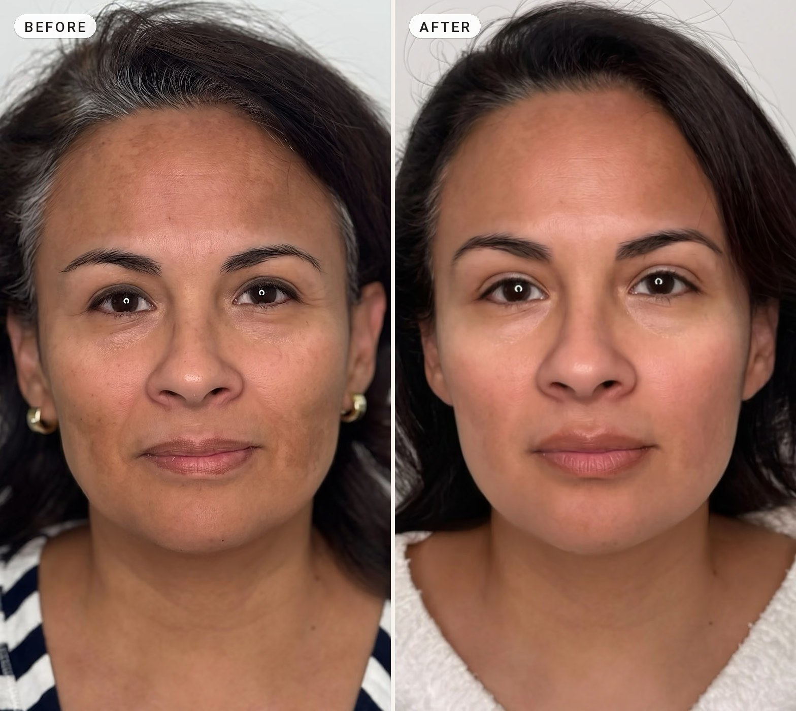 Melasma Treatment 08