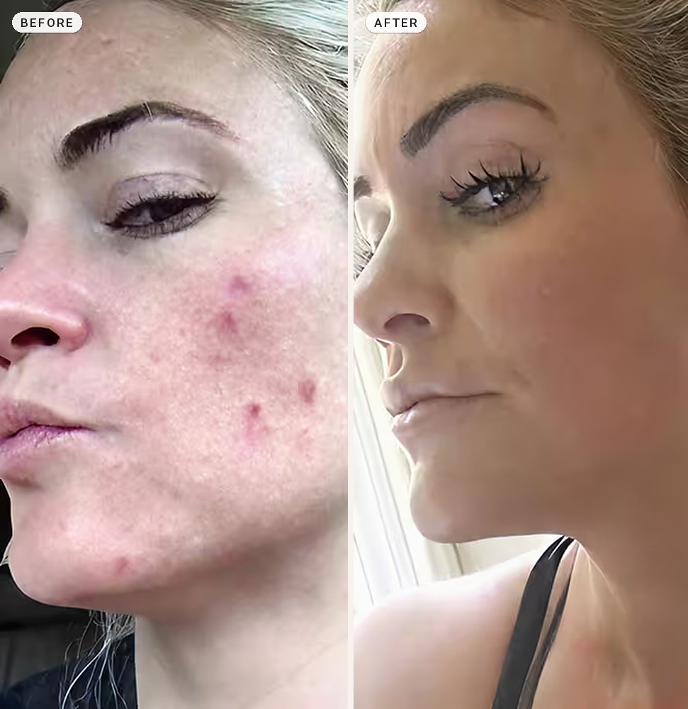 Acne Scar Removal 03