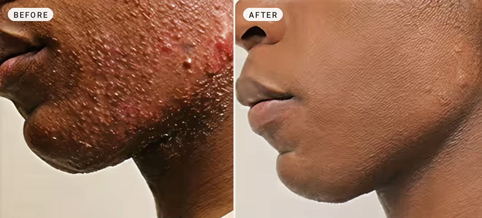 Acne Scar Removal 10