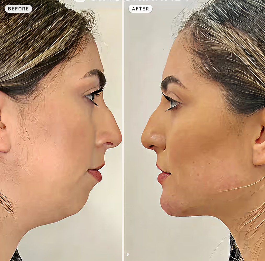 Facial Contouring 01