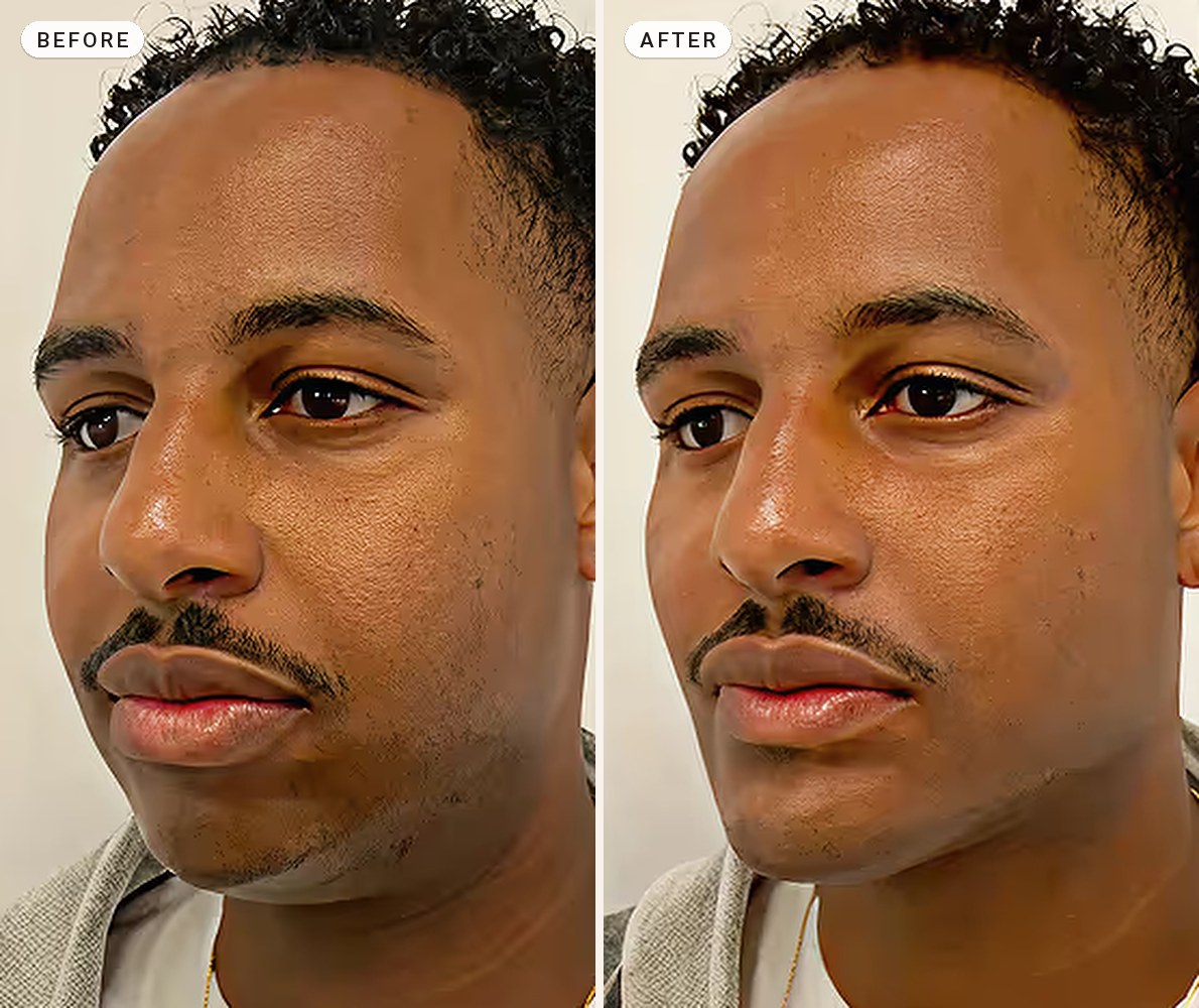 Facial Contouring 02