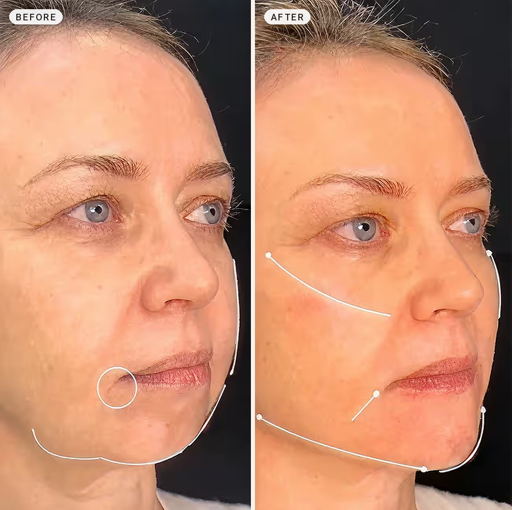 Facial Contouring 03