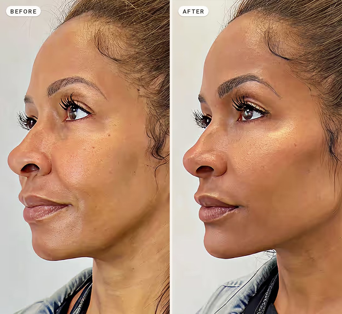 Facial Contouring 04