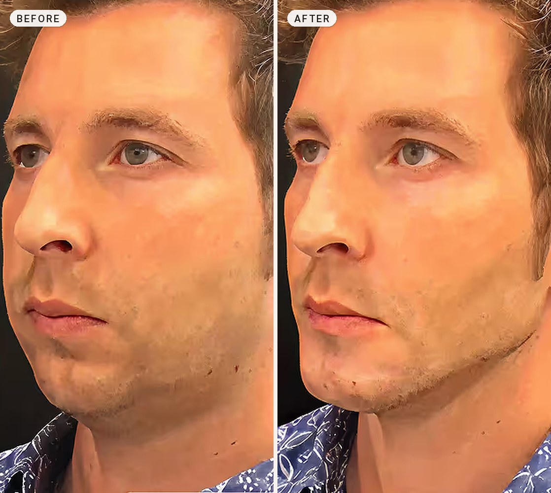 Facial Contouring 07