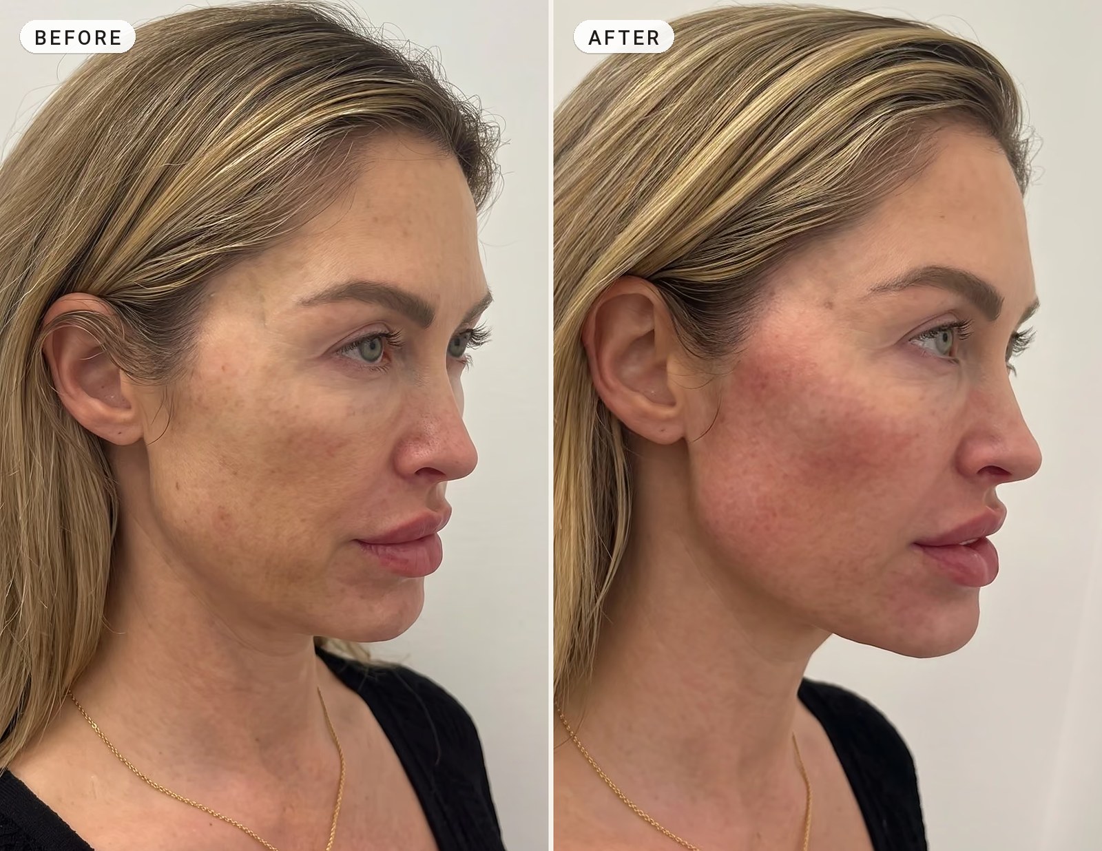 Facial Contouring 09