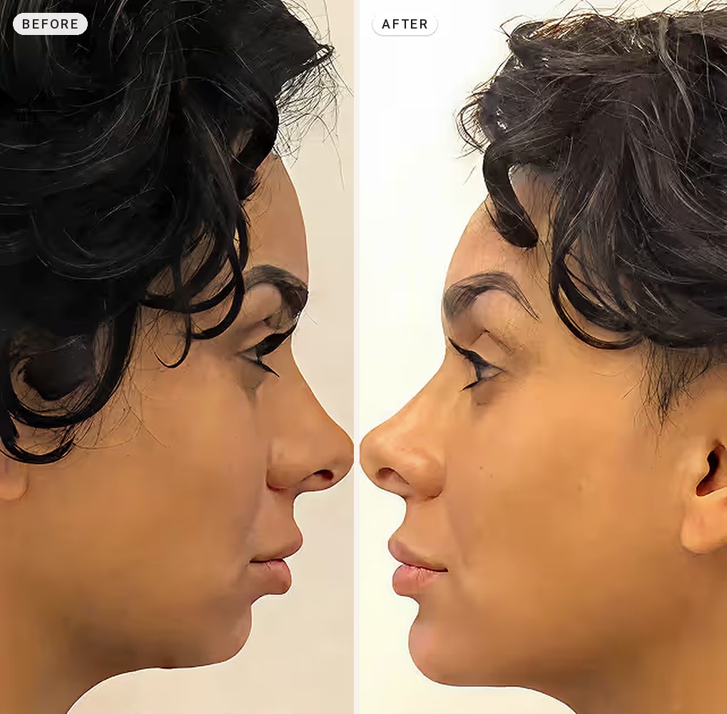 Facial Contouring 08
