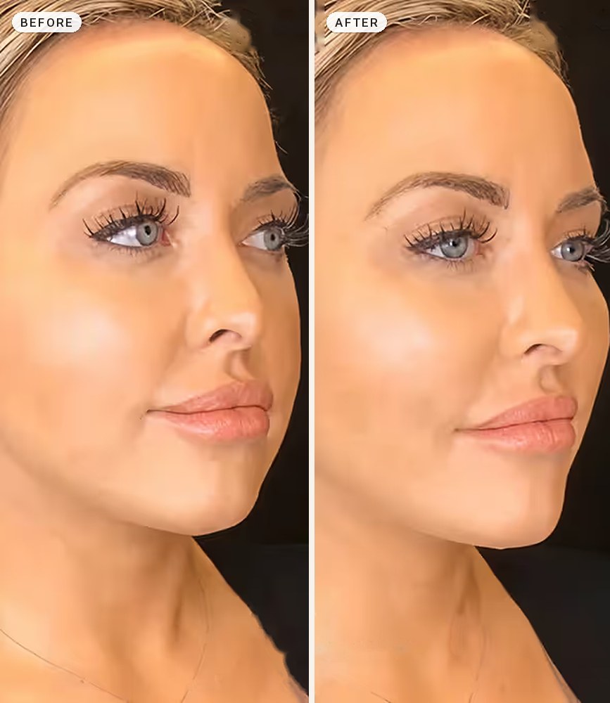 Cheek Contouring 02