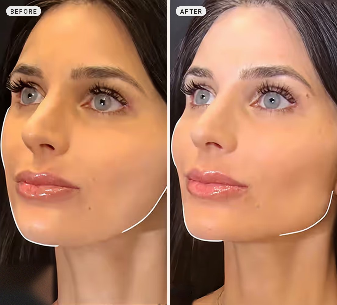 Cheek Contouring 03