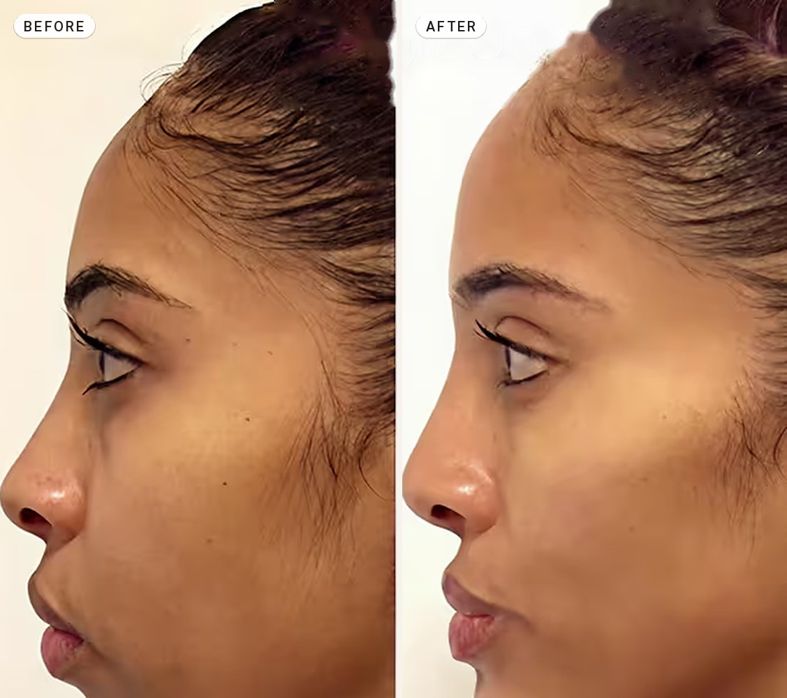 Cheek Contouring 06