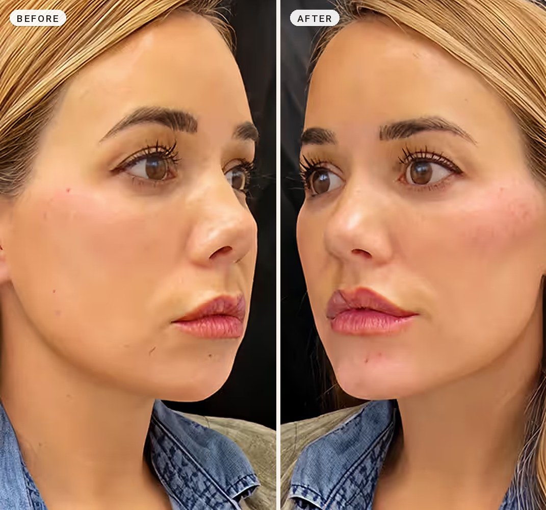 Cheek Contouring 05
