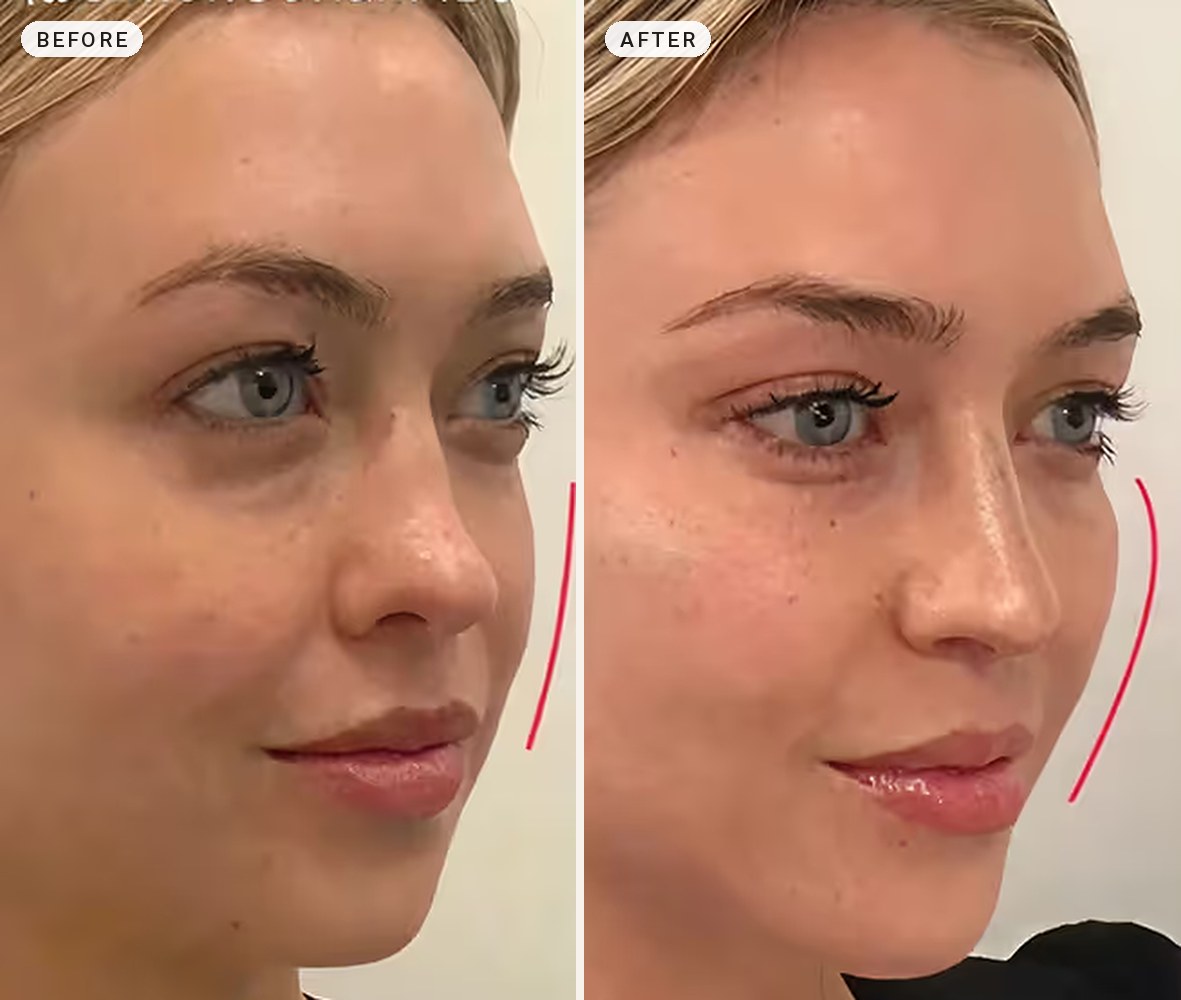 Cheek Contouring 08