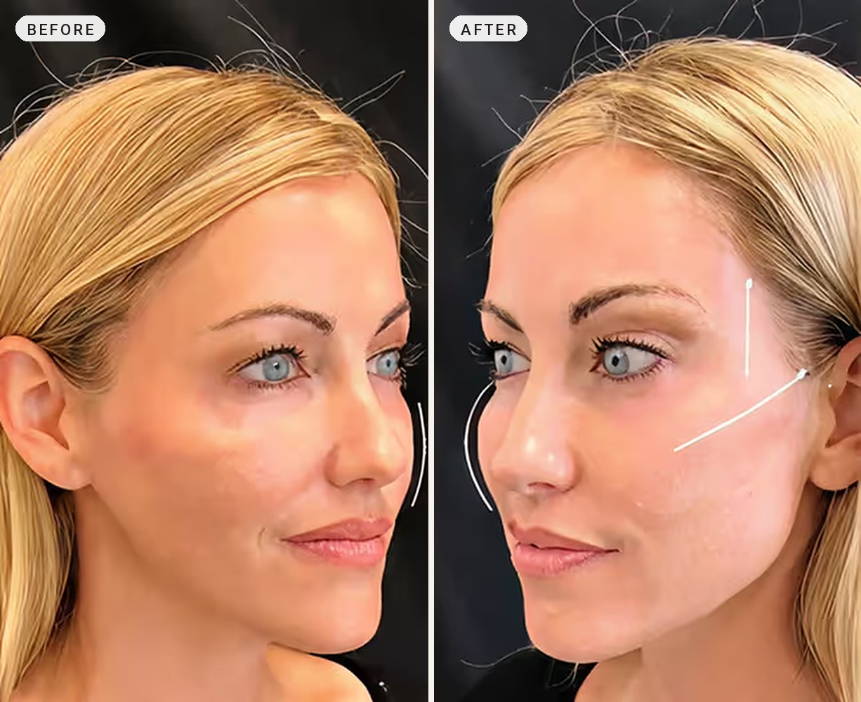 Cheek Contouring 09