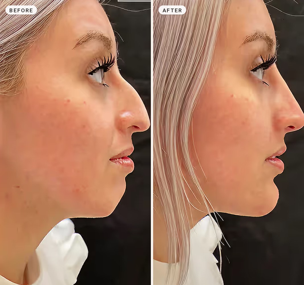 Chin Contouring 01