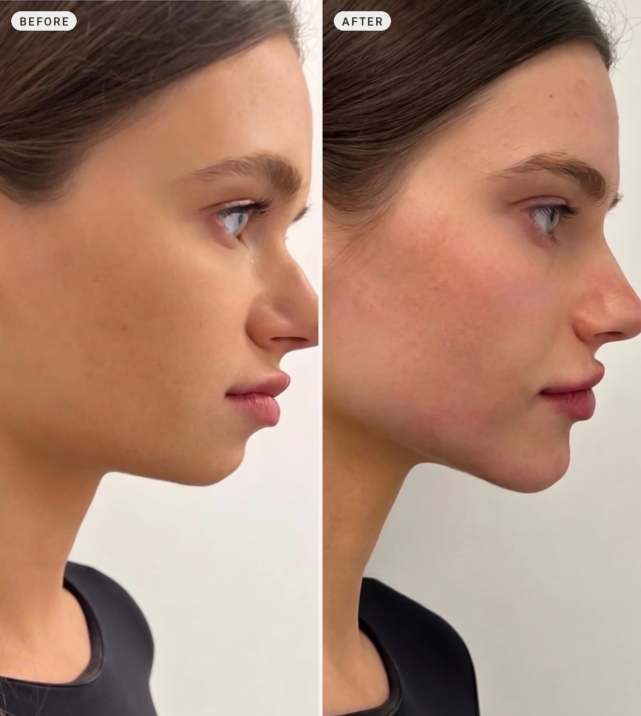 Chin augmentation 08