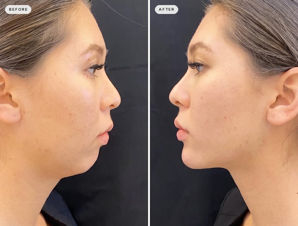 Jawline Contouring 19
