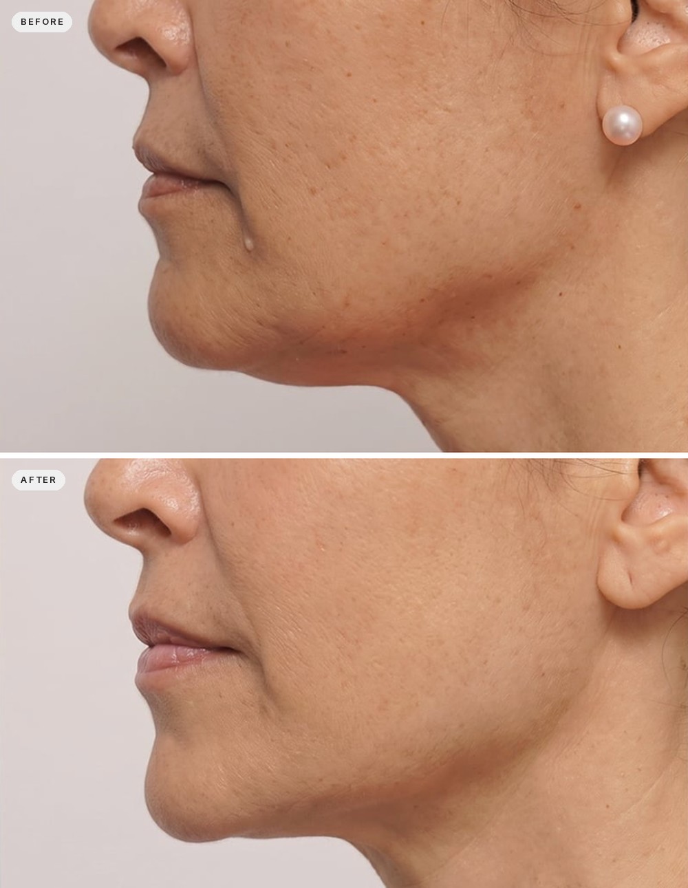 Non Surgical Neck Lift 14