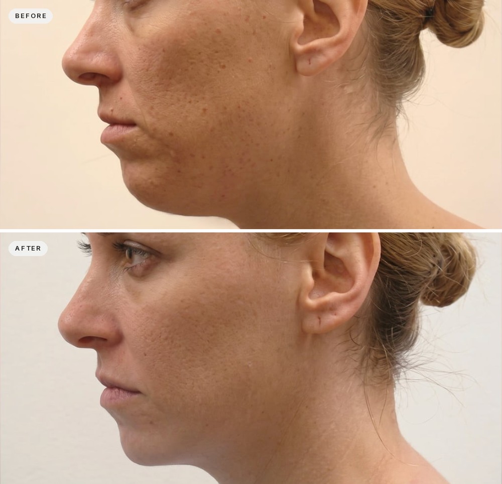 Non Surgical Neck Lift 15