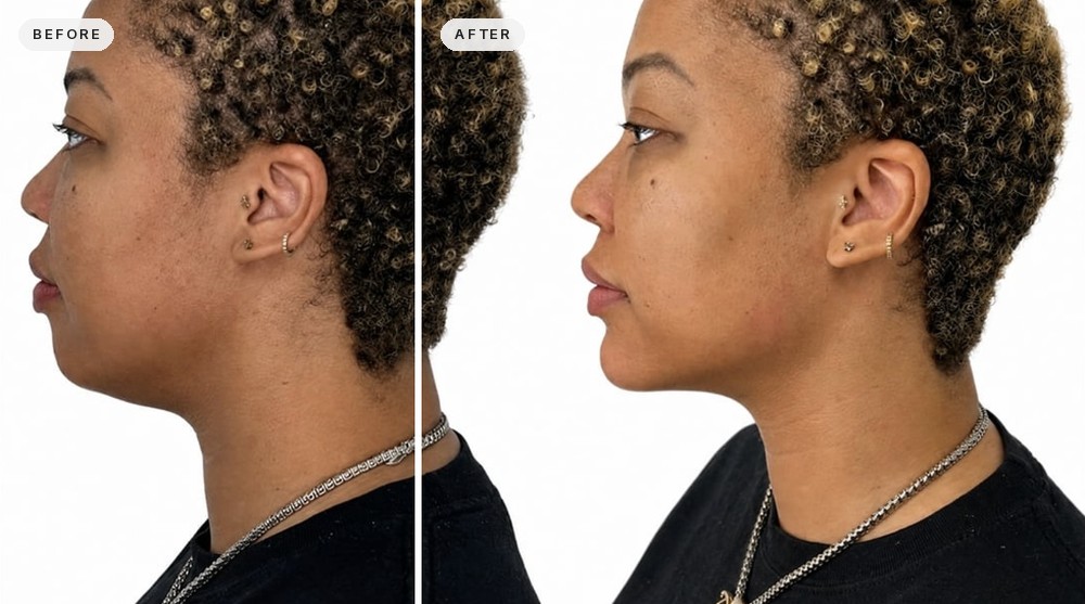Non Surgical Facelift 12