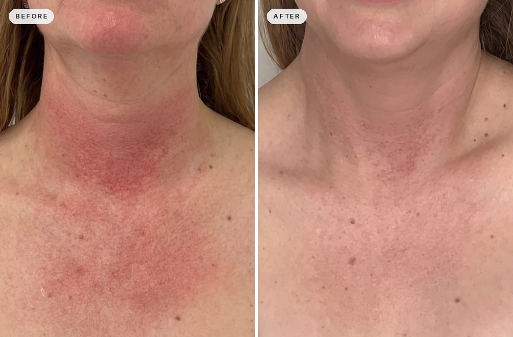 Rosacea & Redness 01