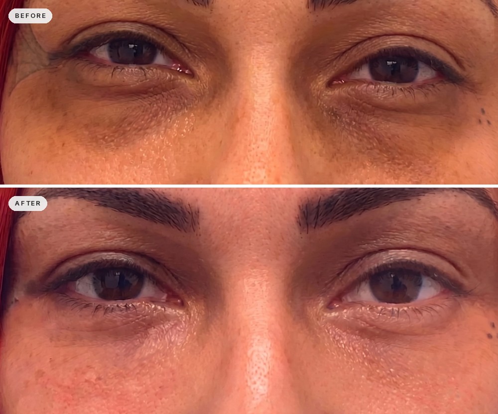 Dark Circles & Eye Bags 37