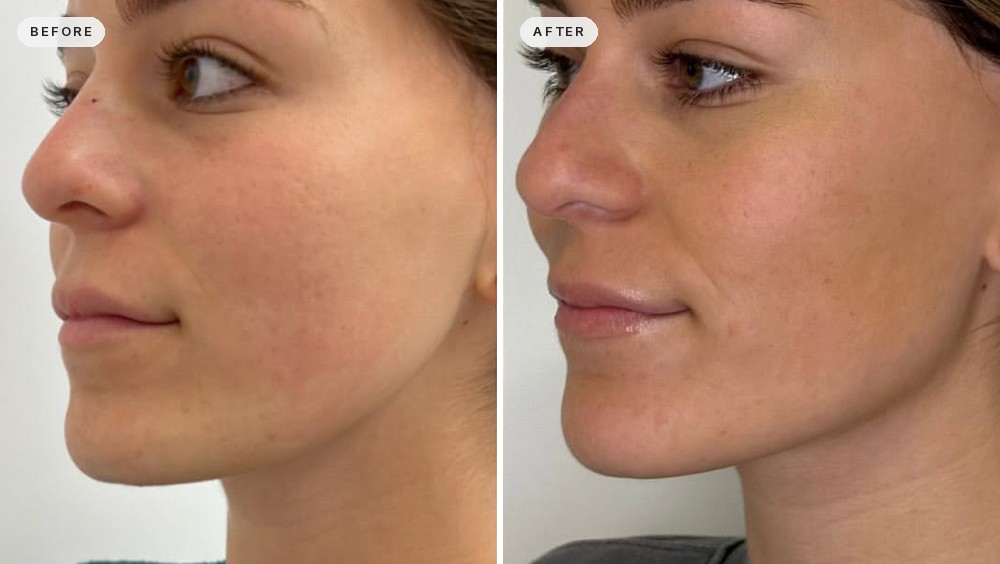 Jawline Contouring 31