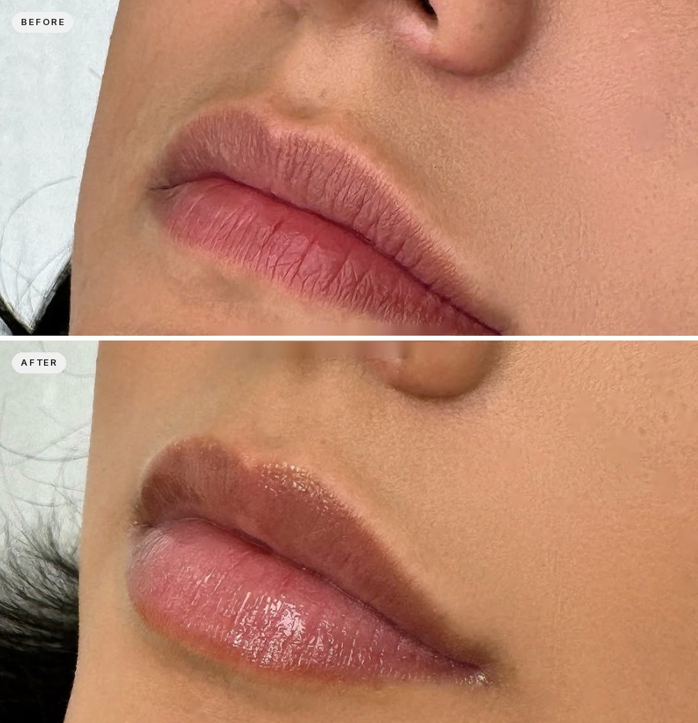 Lip Augmentation 26
