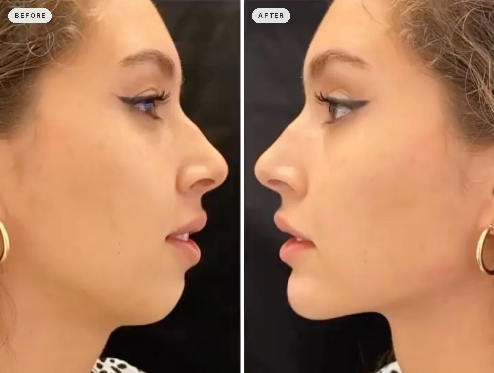 Jawline Contouring 36