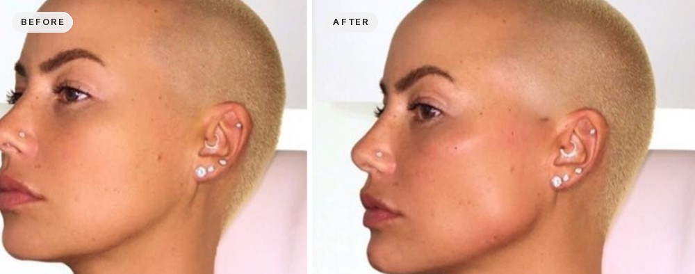 Facial Contouring 18